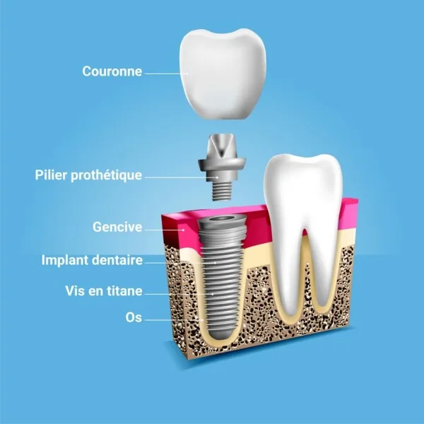 Differentes pieces implant